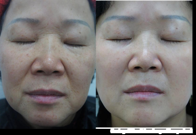 Nouvaderm before and after — texture and tone improvement